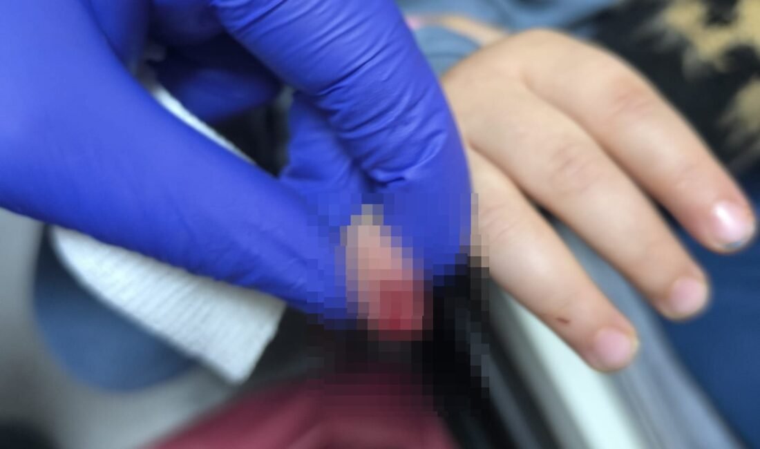 AVM’de yürüyen merdivene eli sıkışan çocuğun parmağı koptu Salih KESKİN/KIZILTEPE (Mardin), (DHA)- MARDİN’in Kızıltepe ilçesinde bir alışveriş merkezindeki